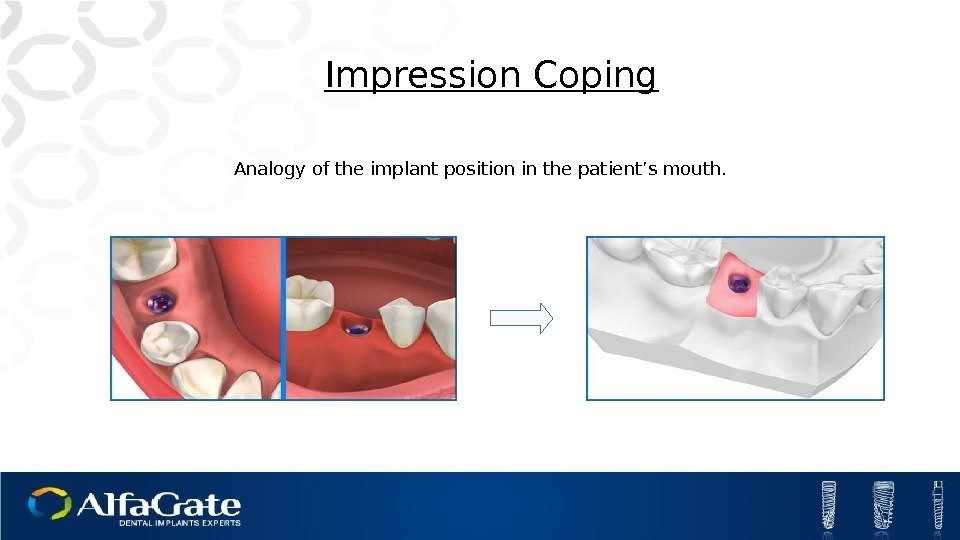 Impression Coping Analogy of the implant position in the patient’s mouth. 