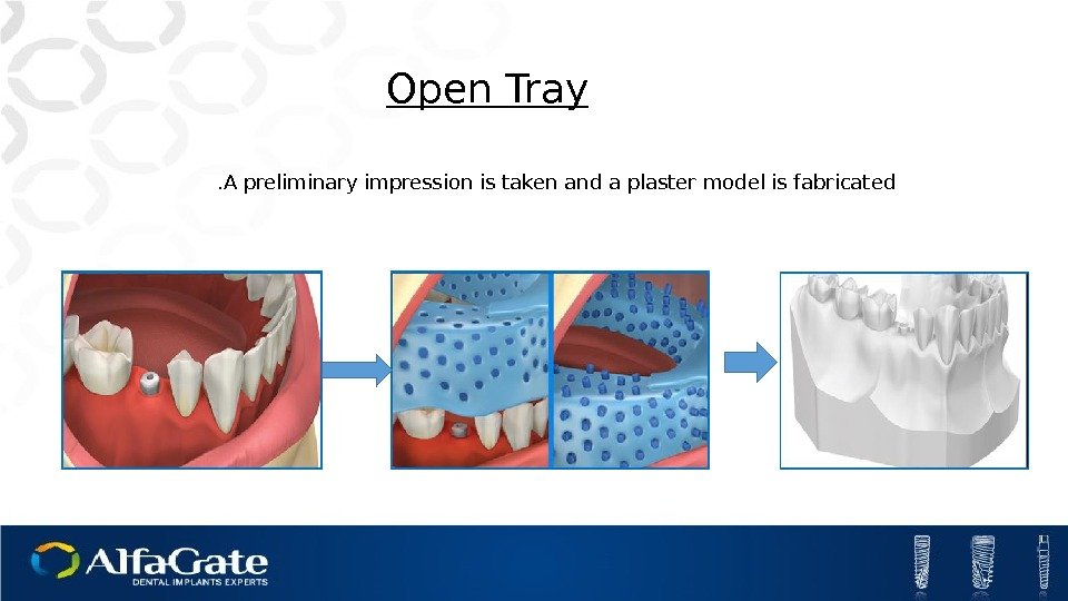 Open Tray A preliminary impression is taken and a plaster model is fabricated. 