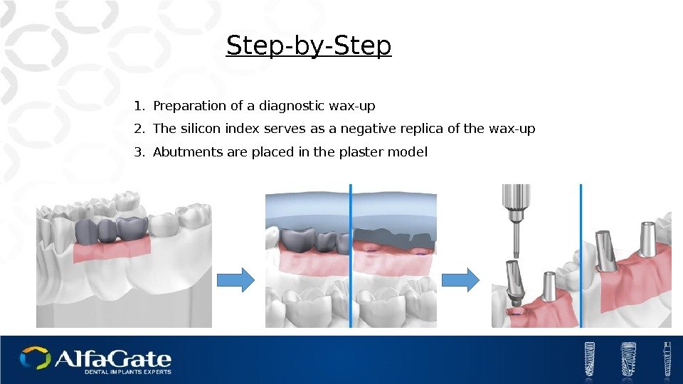 Step-by-Step 1. Preparation of a diagnostic wax-up 2. The silicon index serves as a