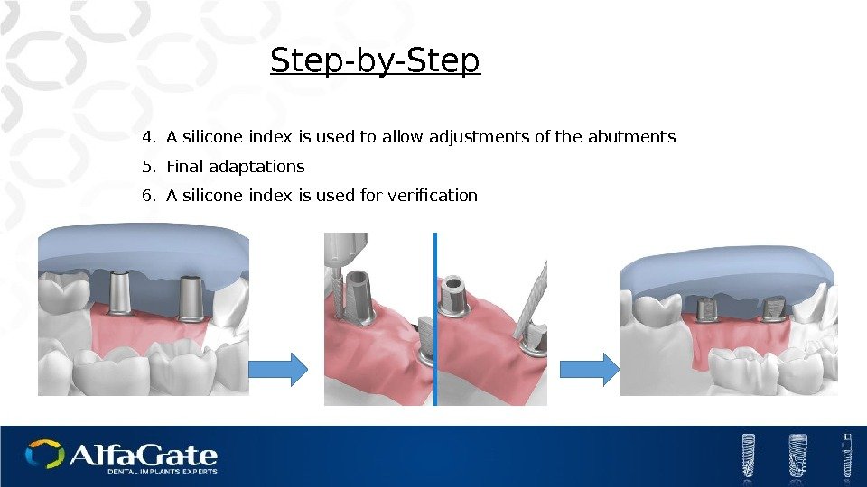 Step-by-Step 4. A silicone index is used to allow adjustments of the abutments 5.