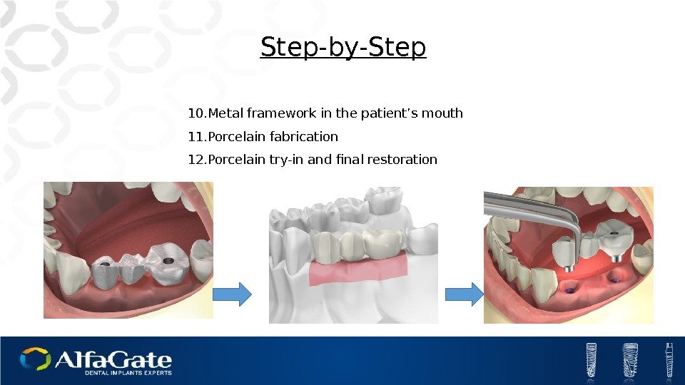 10. Metal framework in the patient’s mouth 11. Porcelain fabrication 12. Porcelain try-in and