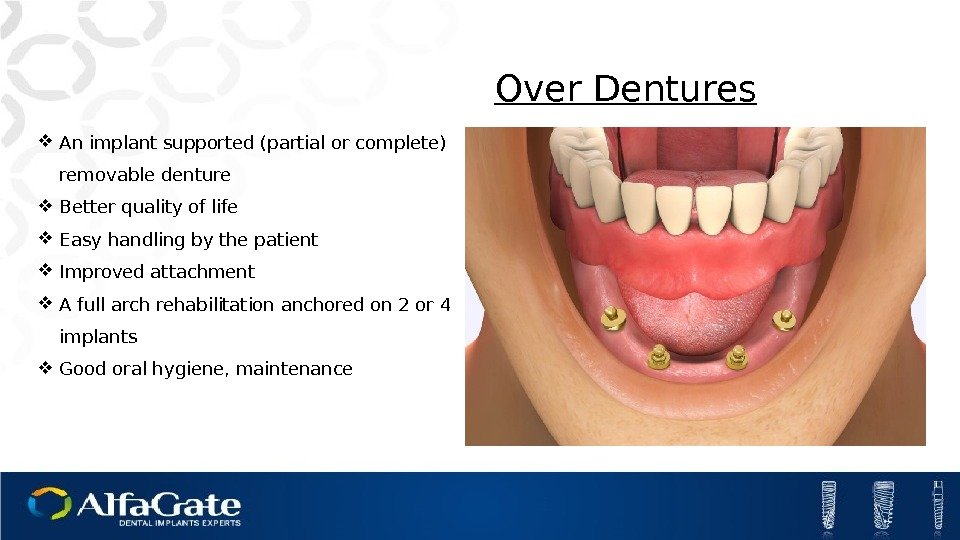 Over Dentures An implant supported (partial or complete) removable denture Better quality of life
