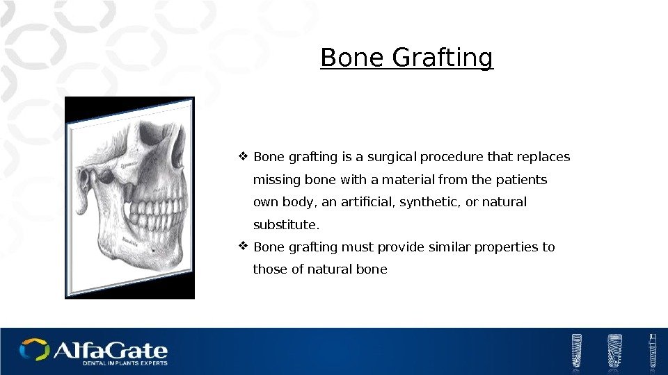  Bone grafting is a surgical procedure that replaces missing bone with a material