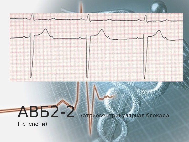 АВБ 2 -2 (атриовентрикулярная блокада II-степени) 