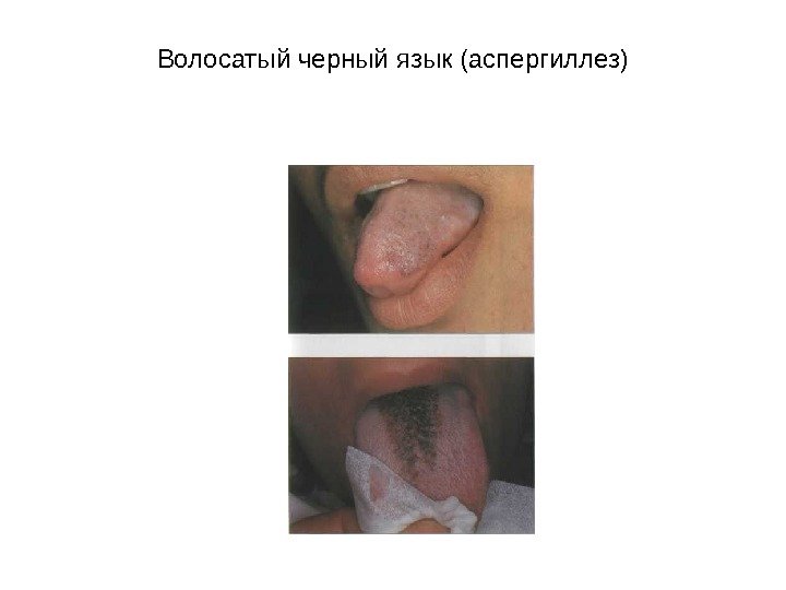   Волосатый черный язык (аспергиллез) 