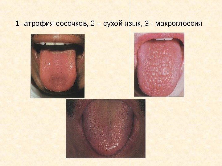   1 - атрофия сосочков, 2 – сухой язык, 3 - макроглоссия 