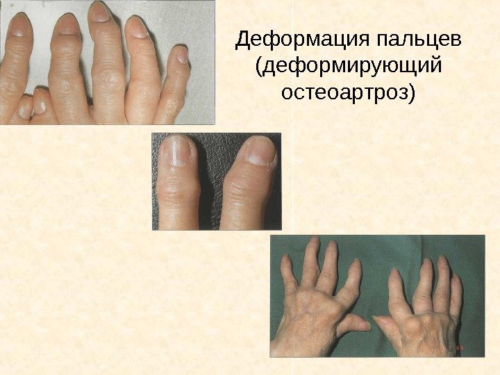   Деформация пальцев (деформирующий остеоартроз) 