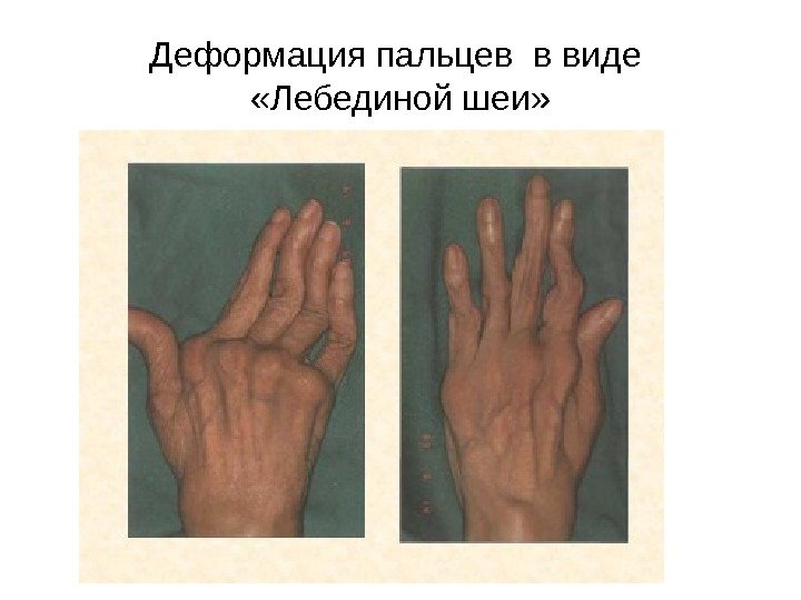   Деформация пальцев в виде  «Лебединой шеи» 