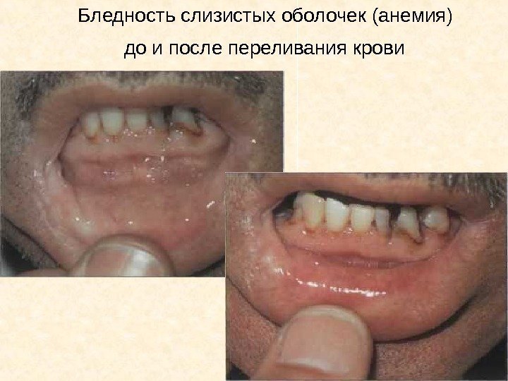   Бледность слизистых оболочек (анемия) до и после переливания крови  