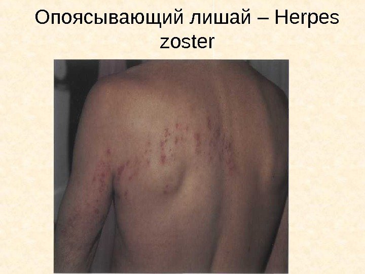   Опоясывающий лишай – Herpes zoster 