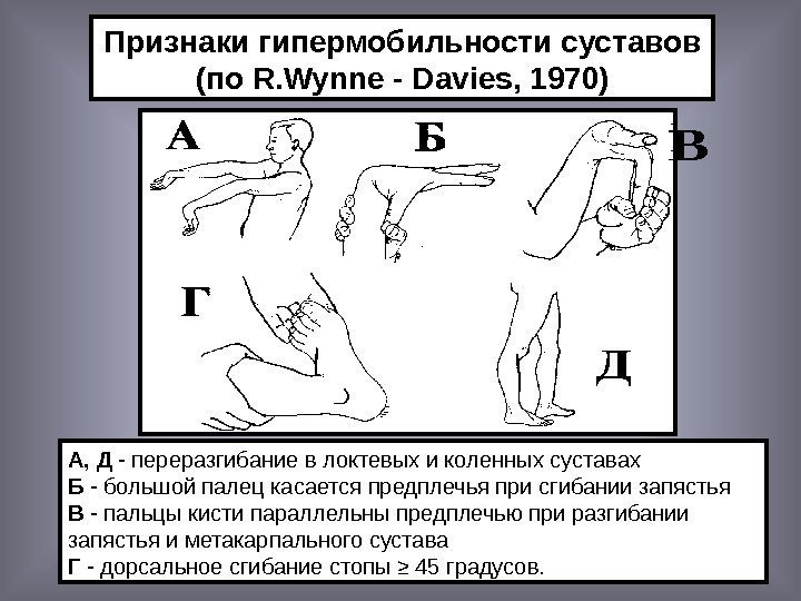   А, Д - переразгибание в локтевых и коленных суставах Б - большой