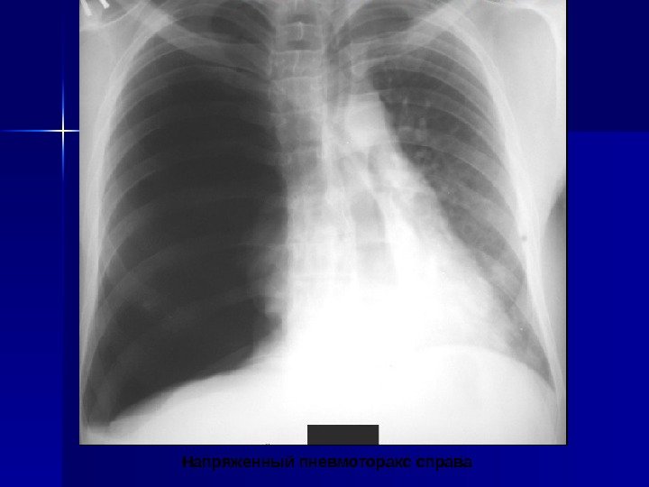  Напряженный пневмоторакс справа 