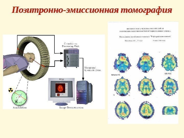 Позитронно-эмиссионная томография 