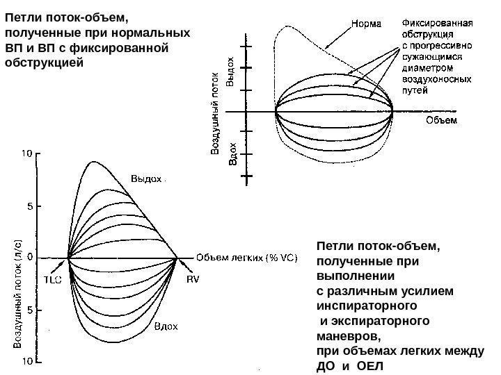 Петли поток-объем,  полученные при нормальных ВП и ВП с фиксированной обструкцией Петли поток-объем,