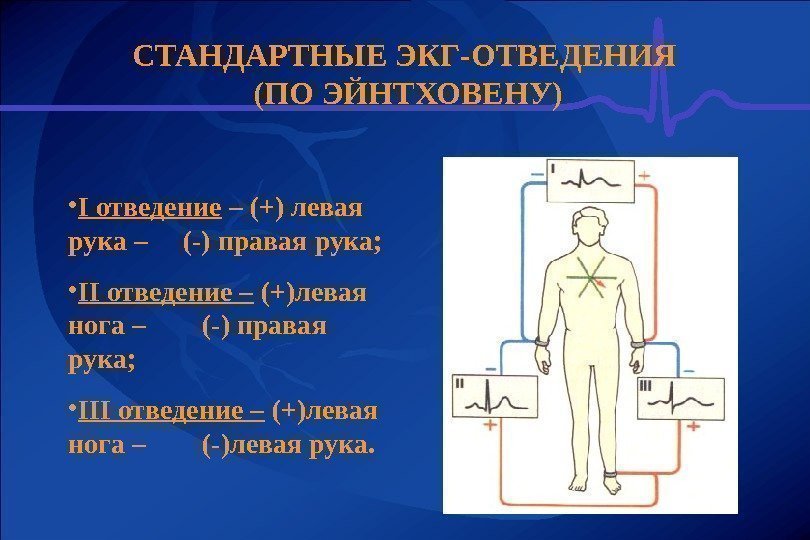 СТАНДАРТНЫЕ ЭКГ-ОТВЕДЕНИЯ (ПО ЭЙНТХОВЕНУ) • I отведение – (+) левая рука – (-) правая