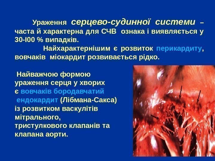   Ураження серцево-судинної системи  – часта й характерна для СЧВ ознака і