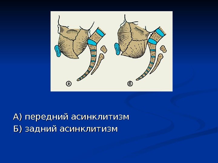 А) передний асинклитизм Б) задний асинклитизм 