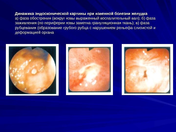 Динамика эндоскопической картины при язвенной болезни желудка а) фаза обострения (вокруг язвы выраженный воспалительный