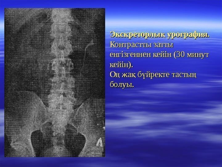 Экскреторлы урография. қ  Контрастты затты енгізгеннен кейін ( 30 30 минут кейін). О