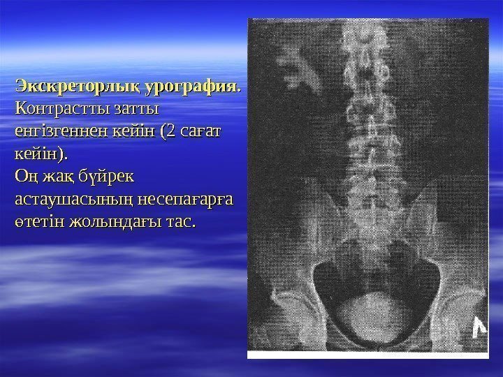 Экскреторлы урография. қ  Контрастты затты енгізгеннен кейін ( 2 2 са ат ғ