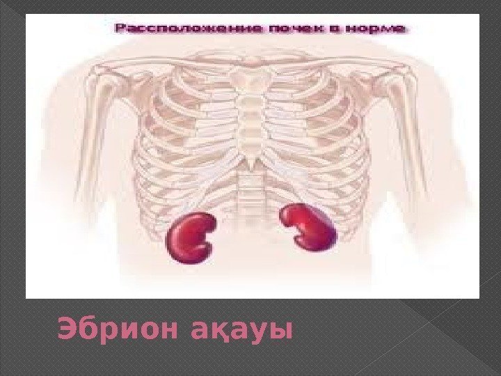 Эбрион ақауы 