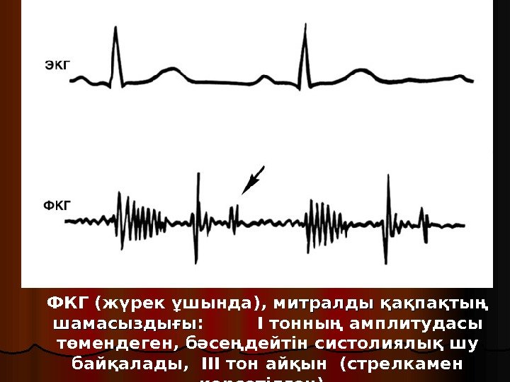 ФКГ (жүрек ұшында), м итралды қақпақтың шамасыздығы :   І тонның амплитудасы төмендеген,