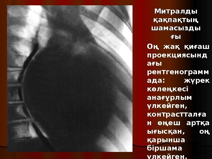 Митралды қақпақтың шамасызды ғығы Оң жақ қиғаш проекциясынд ағы рентгенограмм ада:  жүрек көлеңкесі