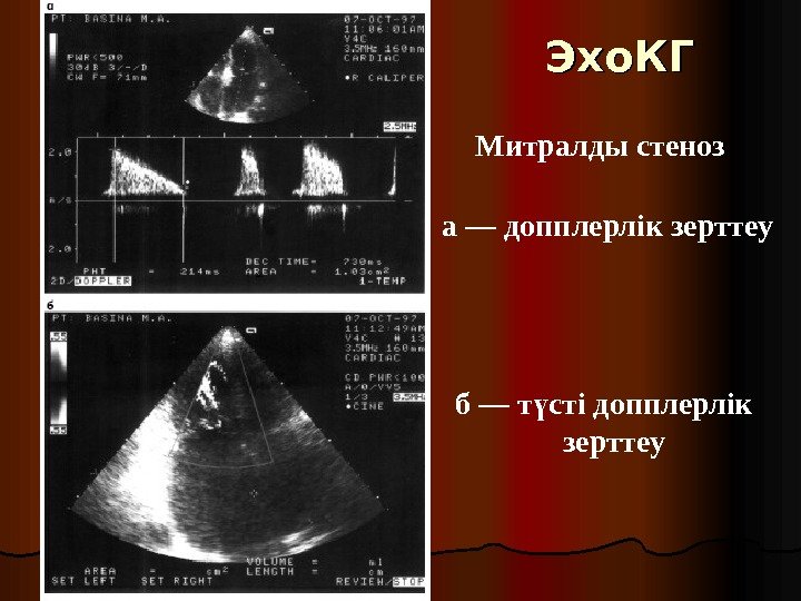 Эхо. КГ Митралды стеноз а — допплерлік зерттеу б — т сті допплерлік ү