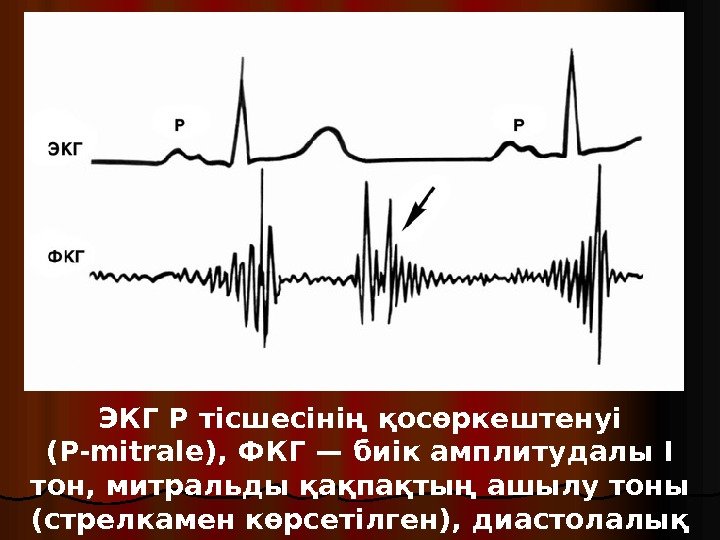 ЭКГ Р тісшесінің қосөркештенуі (P-mitrale), ФКГ— биік амплитудалы I тон, митральды қақпақтың ашылу тоны