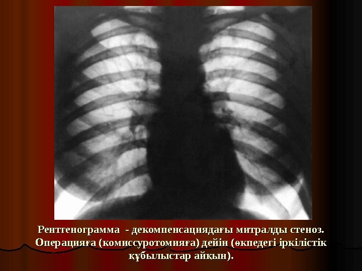 Рентгенограмма  - - декомпенсацияда ы митралды стеноз. ғ Операция а (комиссуротомия а) дейін