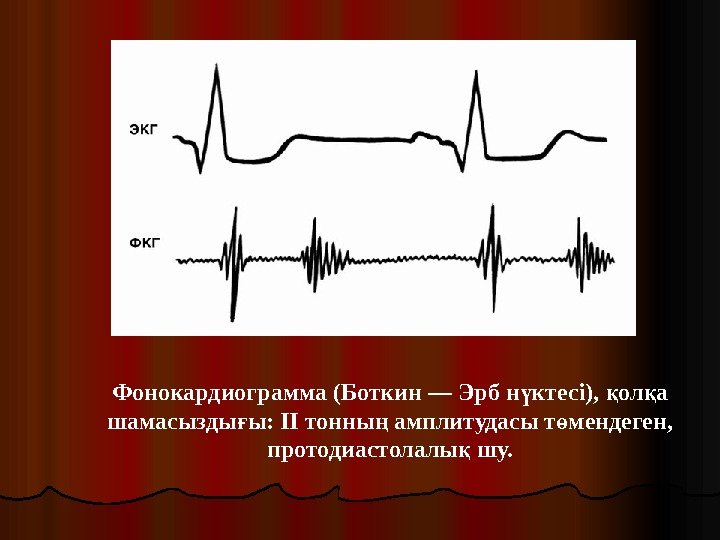 Фонокардиограмма (Боткин — Эрб н ктесі),  ол а ү қ қ шамасызды ы: