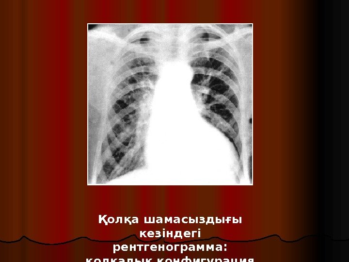 Қолқа шамасыздығы кезіндегі рентгенограмма:  қолқалық конфигурация 