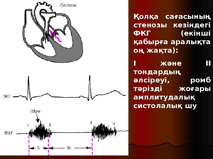 Қолқа сағасының стенозы кезіндегі ФКГ (екінші қабырға аралықта оң жақта): I және II тондардың