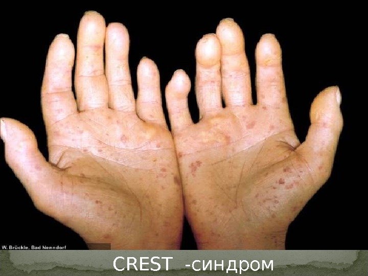 CREST -синдром 