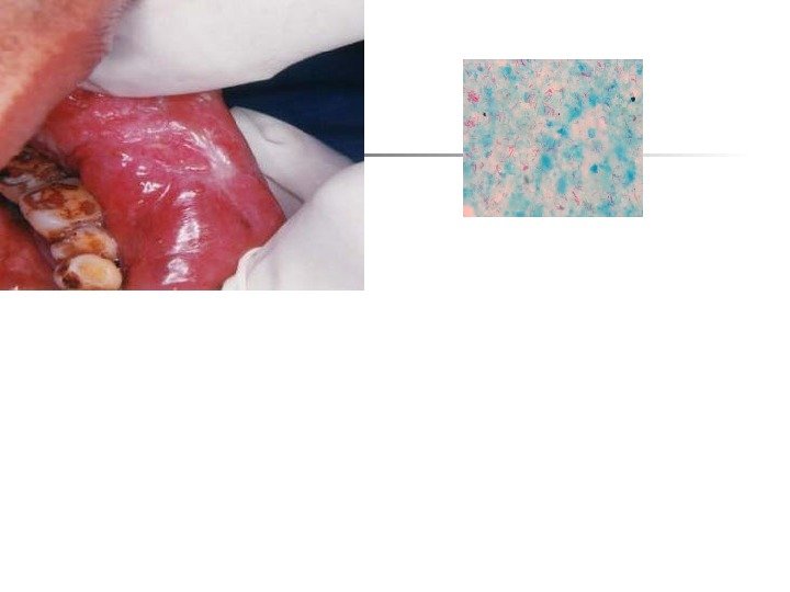 Туберкулезная язва, расположенная на слизистой верхней губы, распространяющаяся на щеку.  