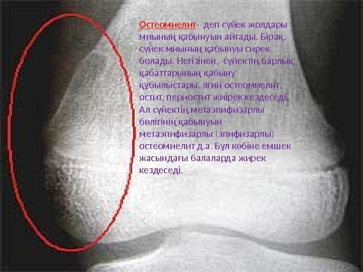 Остеомиелит - деп сүйек жолдары миының қабынуын айтады. Бірақ,  сүйек миының қабынуы сирек