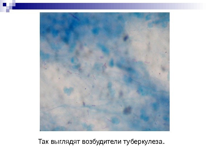 Так выглядят возбудители туберкулеза. Так выглядят возбудители туберкулеза.