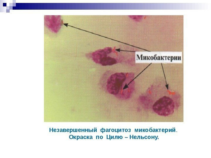 Незавершенный фагоцитоз микобактерий. Окраска по Цилю – Нельсону. Незавершенный фагоцитоз микобактерий. Окраска по Цилю – Нельсону.