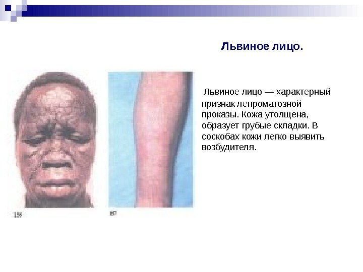 Львиное лицо — характерный признак лепроматозной проказы. Кожа утолщена, Львиное лицо — характерный признак лепроматозной проказы. Кожа утолщена,