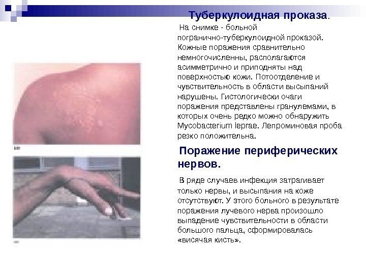 Туберкулоидная проказа. На снимке - Туберкулоидная проказа. На снимке -