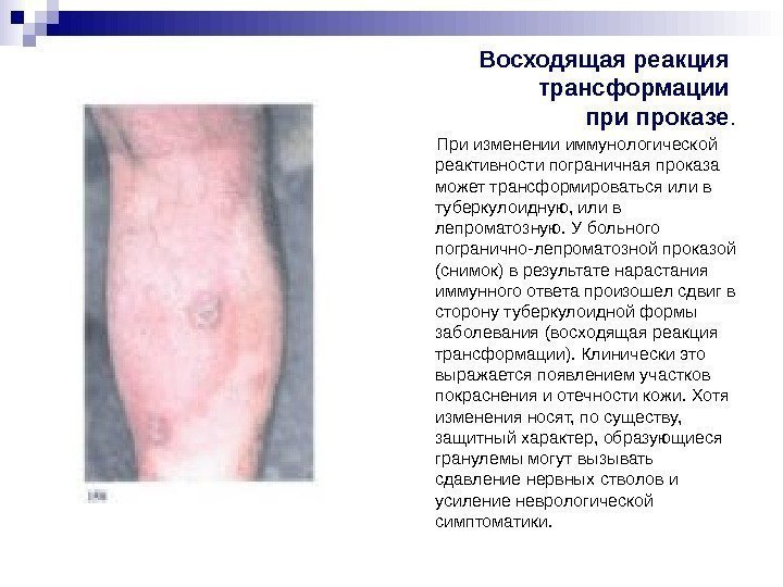 Восходящая реакция трансформации проказе. При изменении иммунологической реактивности пограничная проказа может трансформироваться Восходящая реакция трансформации проказе. При изменении иммунологической реактивности пограничная проказа может трансформироваться