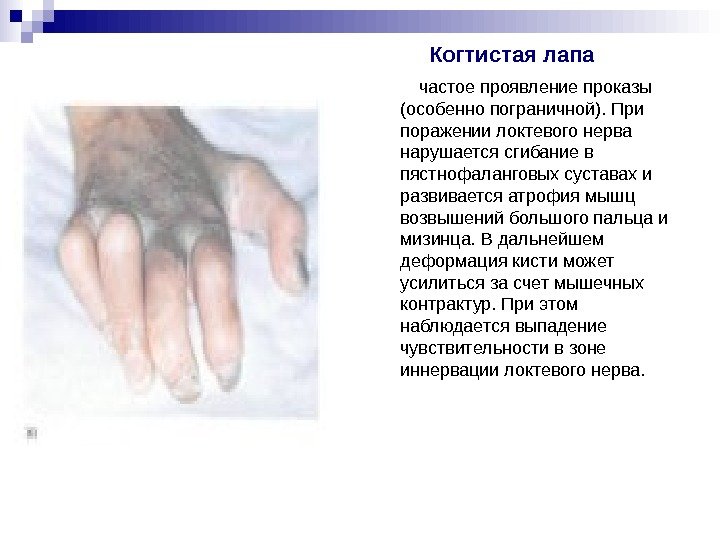 Когтистая лапа частое проявление проказы (особенно Когтистая лапа частое проявление проказы (особенно