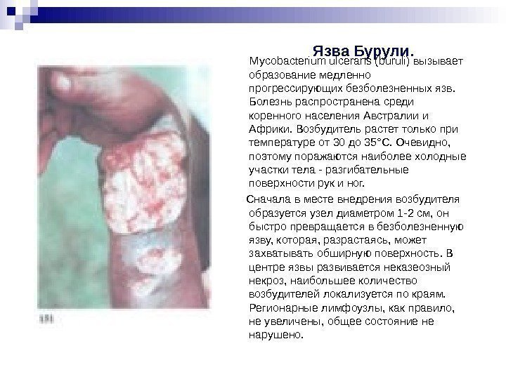 Язва Бурули. Mycobacterium ulcerans (buruli) вызывает Язва Бурули. Mycobacterium ulcerans (buruli) вызывает
