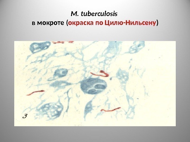 M. tuberculosis  в мокроте ( окраска по Цилю-Нильсену ) 