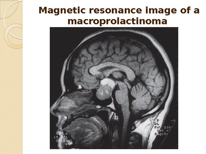 Magnetic resonance image of a macroprolactinoma  