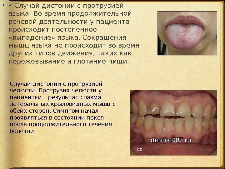  •  Случай дистонии с протрузией языка. Во время продолжительной речевой деятельности у