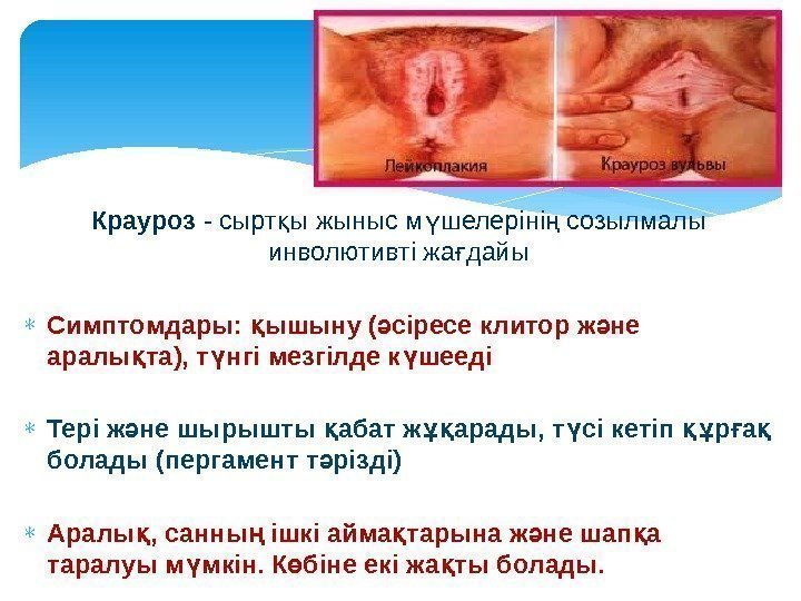 Крауроз - сырт ы жыныс м шелеріні созылмалы қ ү ң инволютивті жа дайы