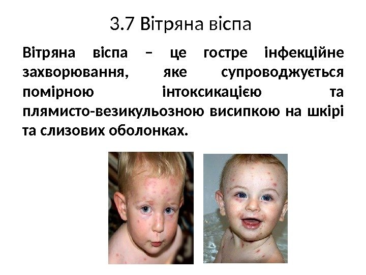 3. 7 Вітряна віспа – це гостре інфекційне захворювання,  яке супроводжується помірною інтоксикацією