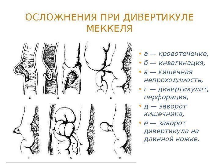 ОСЛОЖНЕНИЯ ПРИ ДИВЕРТИКУЛЕ МЕККЕЛЯ • а— кровотечение,  • б — инвагинация,  •