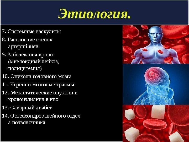 Этиология. 7. Системные васкулиты 8. Расслоение стенок артерий шеи 9. Заболевания крови (миелоидный лейкоз,